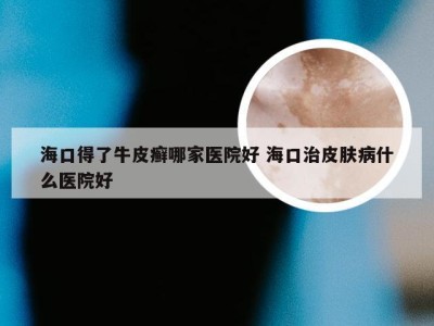 海口得了牛皮癣哪家医院好 海口治皮肤病什么医院好