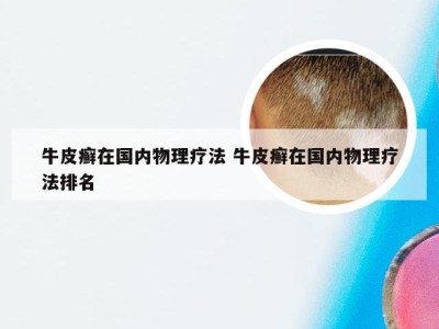 牛皮癣在国内物理疗法 牛皮癣在国内物理疗法排名