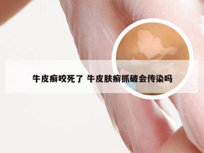 牛皮癣咬死了 牛皮肤癣抓破会传染吗