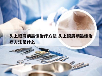 头上银屑病最佳治疗方法 头上银屑病最佳治疗方法是什么