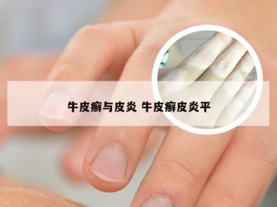 牛皮癣与皮炎 牛皮癣皮炎平