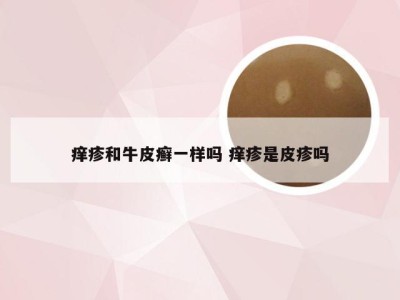 痒疹和牛皮癣一样吗 痒疹是皮疹吗
