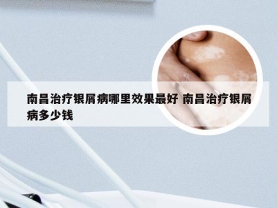 南昌治疗银屑病哪里效果最好 南昌治疗银屑病多少钱