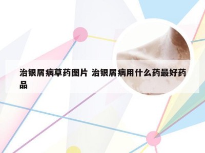 治银屑病草药图片 治银屑病用什么药最好药品