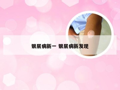 银屑病新一 银屑病新发现