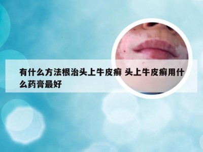 有什么方法根治头上牛皮癣 头上牛皮癣用什么药膏最好