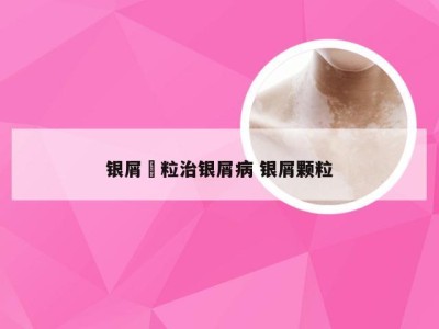 银屑粿粒治银屑病 银屑颗粒
