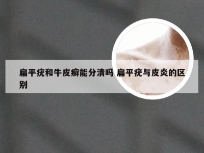 扁平疣和牛皮癣能分清吗 扁平疣与皮炎的区别