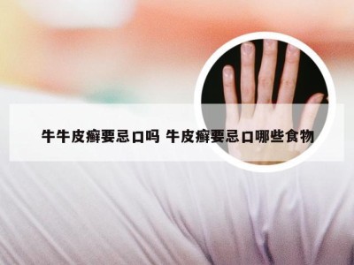 牛牛皮癣要忌口吗 牛皮癣要忌口哪些食物