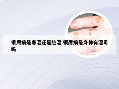 银屑病是寒湿还是热湿 银屑病是身体有湿毒吗