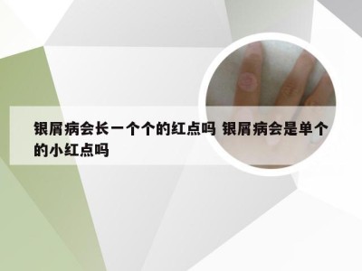 银屑病会长一个个的红点吗 银屑病会是单个的小红点吗