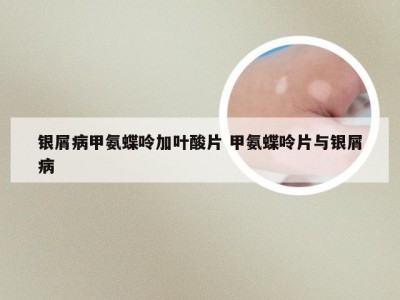 银屑病甲氨蝶呤加叶酸片 甲氨蝶呤片与银屑病