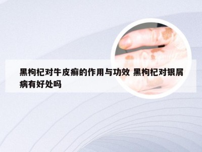 黑枸杞对牛皮癣的作用与功效 黑枸杞对银屑病有好处吗
