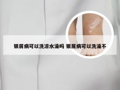 银屑病可以洗凉水澡吗 银屑病可以洗澡不