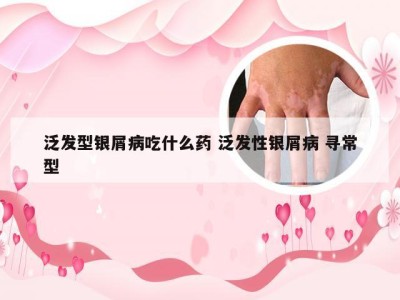 泛发型银屑病吃什么药 泛发性银屑病 寻常型