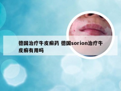 德国治疗牛皮癣药 德国sorion治疗牛皮癣有用吗