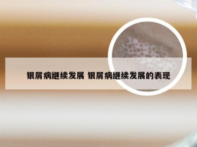 银屑病继续发展 银屑病继续发展的表现