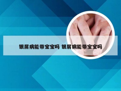 银屑病能带宝宝吗 银屑病能带宝宝吗