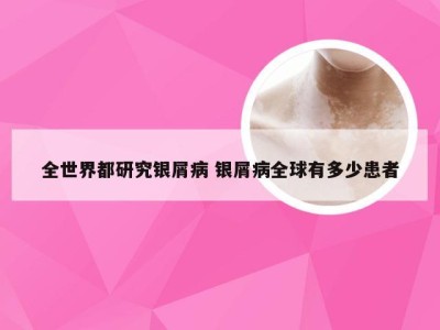 全世界都研究银屑病 银屑病全球有多少患者