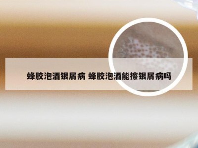 蜂胶泡酒银屑病 蜂胶泡酒能擦银屑病吗