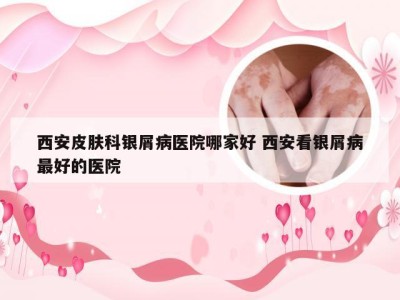 西安皮肤科银屑病医院哪家好 西安看银屑病最好的医院
