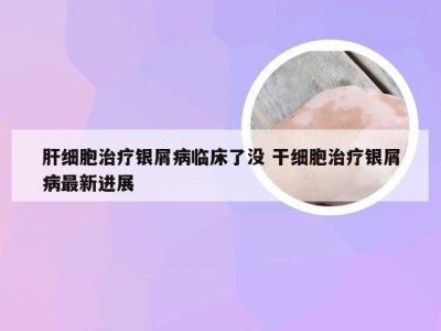 肝细胞治疗银屑病临床了没 干细胞治疗银屑病最新进展