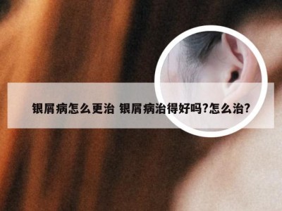 银屑病怎么更治 银屑病治得好吗?怎么治?