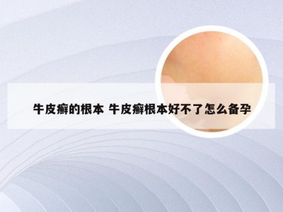 牛皮癣的根本 牛皮癣根本好不了怎么备孕