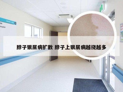 脖子银屑病扩散 脖子上银屑病越挠越多