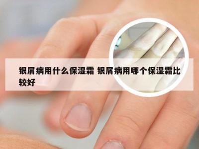 银屑病用什么保湿霜 银屑病用哪个保湿霜比较好
