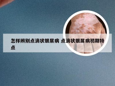 怎样辨别点滴状银屑病 点滴状银屑病初期特点