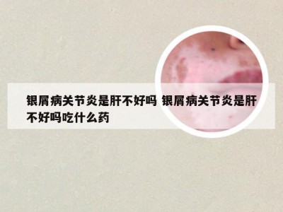 银屑病关节炎是肝不好吗 银屑病关节炎是肝不好吗吃什么药
