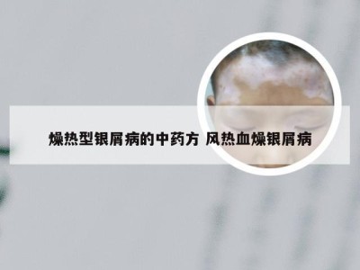 燥热型银屑病的中药方 风热血燥银屑病