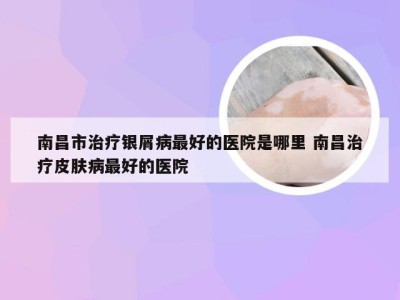 南昌市治疗银屑病最好的医院是哪里 南昌治疗皮肤病最好的医院