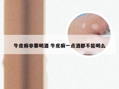 牛皮癣非要喝酒 牛皮癣一点酒都不能喝么