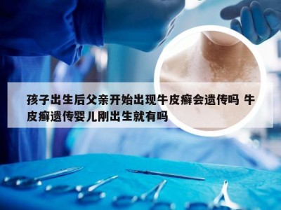 孩子出生后父亲开始出现牛皮癣会遗传吗 牛皮癣遗传婴儿刚出生就有吗