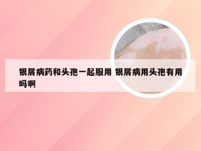 银屑病药和头孢一起服用 银屑病用头孢有用吗啊
