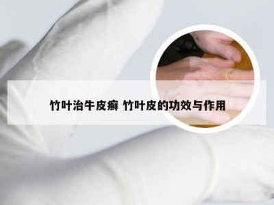 竹叶治牛皮癣 竹叶皮的功效与作用