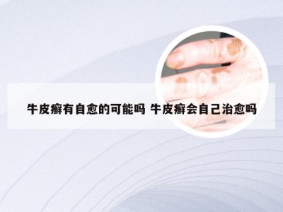 牛皮癣有自愈的可能吗 牛皮癣会自己治愈吗