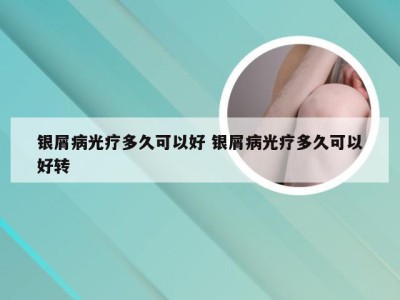 银屑病光疗多久可以好 银屑病光疗多久可以好转