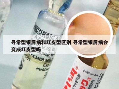 寻常型银屑病和红皮型区别 寻常型银屑病会变成红皮型吗