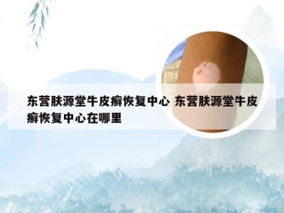 东营肤源堂牛皮癣恢复中心 东营肤源堂牛皮癣恢复中心在哪里