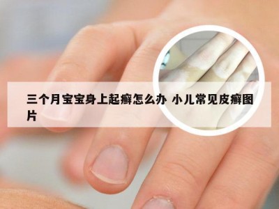 三个月宝宝身上起癣怎么办 小儿常见皮癣图片