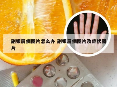 副银屑病图片怎么办 副银屑病图片及症状图片