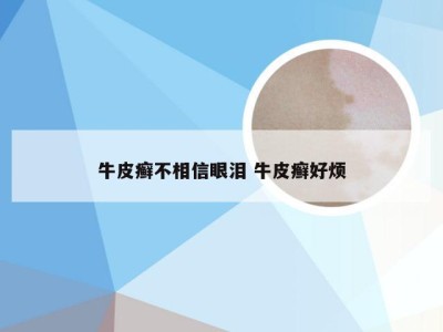 牛皮癣不相信眼泪 牛皮癣好烦