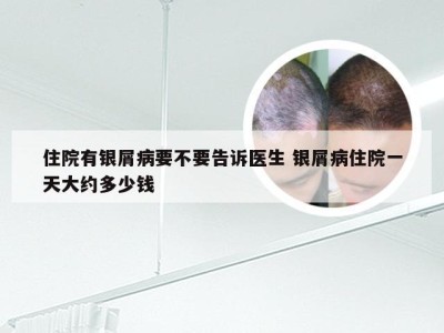 住院有银屑病要不要告诉医生 银屑病住院一天大约多少钱