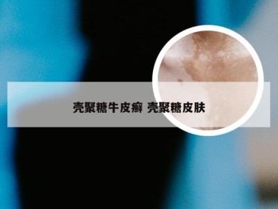 壳聚糖牛皮癣 壳聚糖皮肤