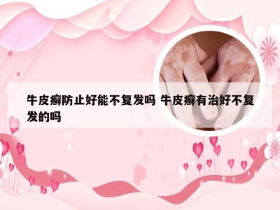 牛皮癣防止好能不复发吗 牛皮癣有治好不复发的吗