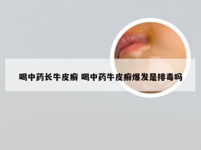 喝中药长牛皮癣 喝中药牛皮癣爆发是排毒吗