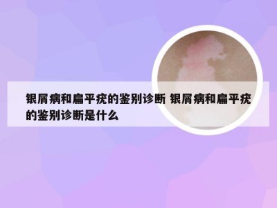 银屑病和扁平疣的鉴别诊断 银屑病和扁平疣的鉴别诊断是什么